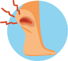 PLANTAR FASCIITIS