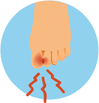 BUNION PAIN
